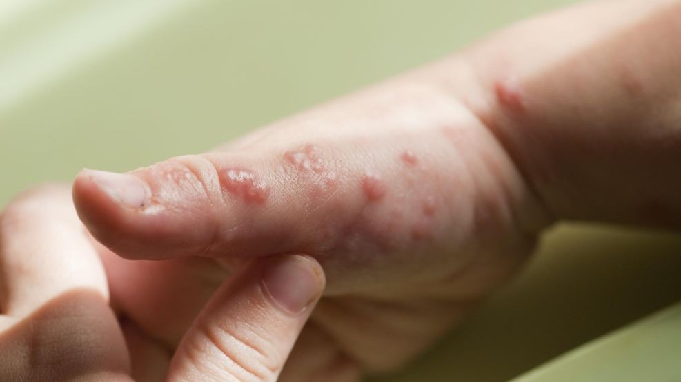 Detectan en Argentina el primer caso de una variante más contagiosa de viruela del mono | Actualidad