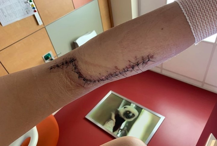 Al volver de la playa su hija de 12 años no podía caminar: casi muere por la bacteria "come carne" | Internacionales