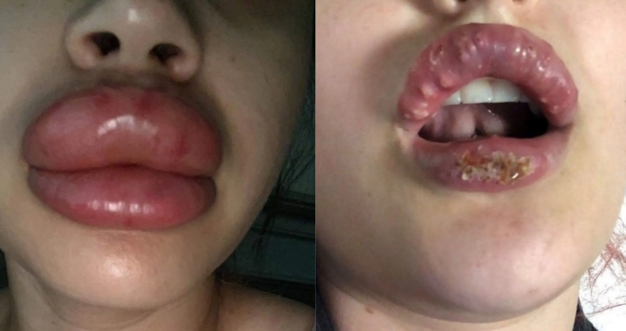 Quisieron pagar menos por un retoque estético y así le quedaron los labios | Internacionales