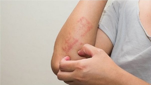 Pacientes con la leucemia más frecuente ya pueden tratarse sin quimioterapia | Actualidad