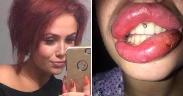 Pagó 200 dólares para una cirugía estética y casi pierde los labios | Curiosidades