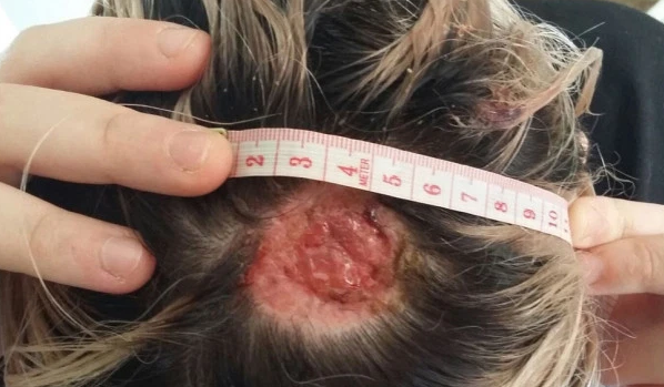 Fue a una peluquería a teñirse el pelo de rosa y perdió parte de su cuero cabelludo | Curiosidades