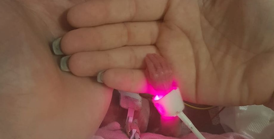 El milagro de Isabella: cuando nació pesaba 340 gramos y sus manos eran más chicas que una moneda | Internacionales