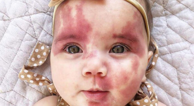 La lección viral de una madre a los que llamaron "fea" a su hija por tener marcas de nacimiento | Curiosidades