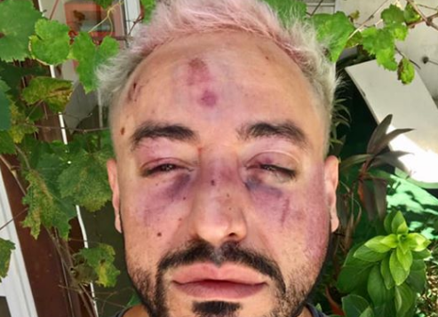 Brutal ataque homofóbico de una patota a un joven diseñador | Actualidad