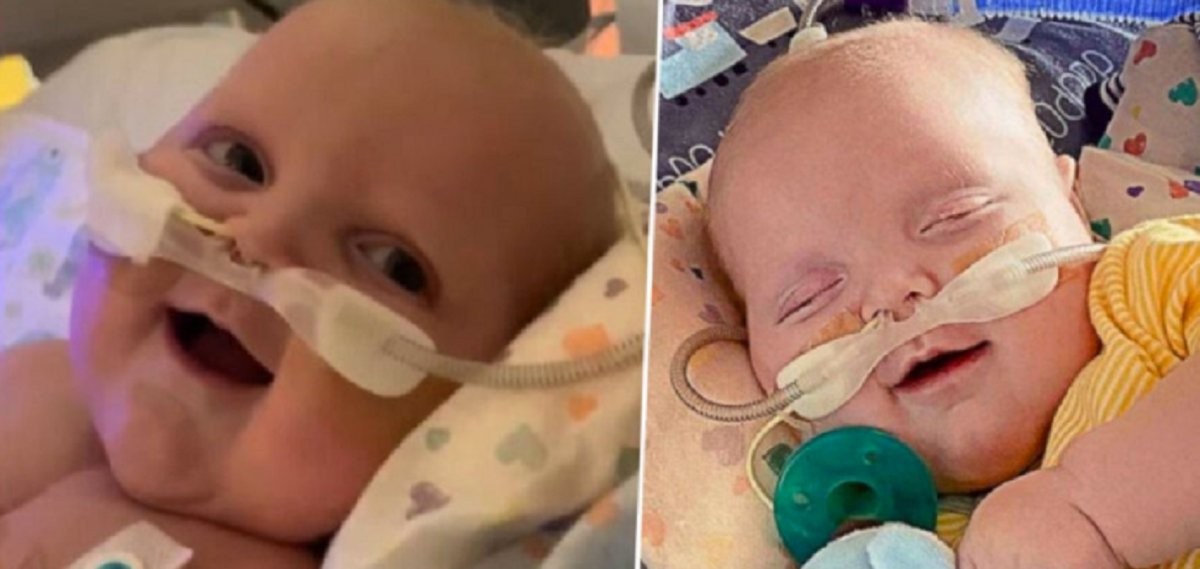 Foto conmovedora: la primera sonrisa de un bebé que fue operado dos veces del corazón | Curiosidades