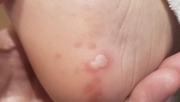 Estudio: las cinco manifestaciones del coronavirus en la piel de los enfermos | Actualidad