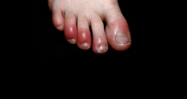 "Dedos coronavirus": el doloroso síntoma de covid-19 que advierten los dermatólogos | Internacionales