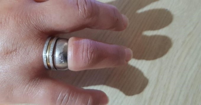 La historia de la mujer que se le trabó un anillo y tuvo que llamar a los bomberos para que la salven | Actualidad