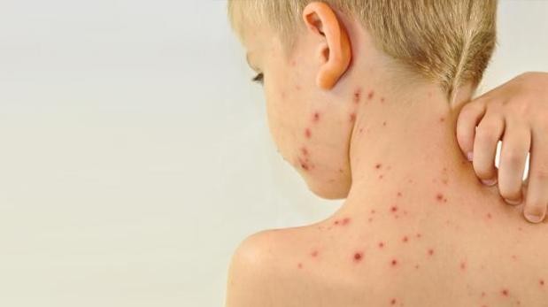 Argentina anunció que controló el brote de sarampión | Actualidad