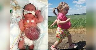 La nena que desafió los pronósticos médicos y sobrevive con sus órganos fuera del cuerpo | Internacionales