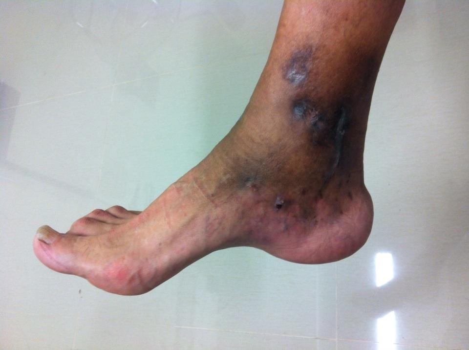 Micetoma: una enfermedad curable a la que llaman "muerte silenciosa" | Salud