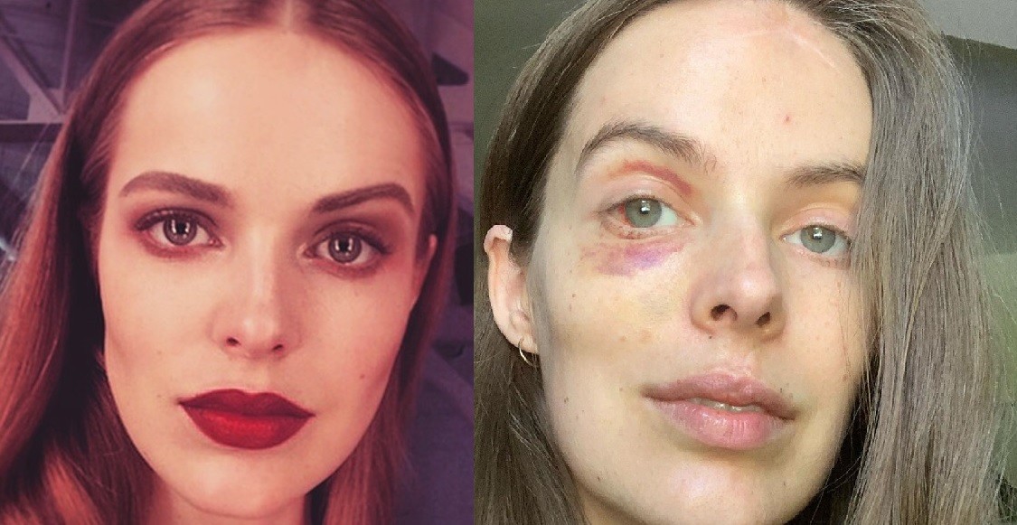 "Mostrar el verdadero yo": modelo exhibe en redes las lesiones de las enfermedades que padece | Redes