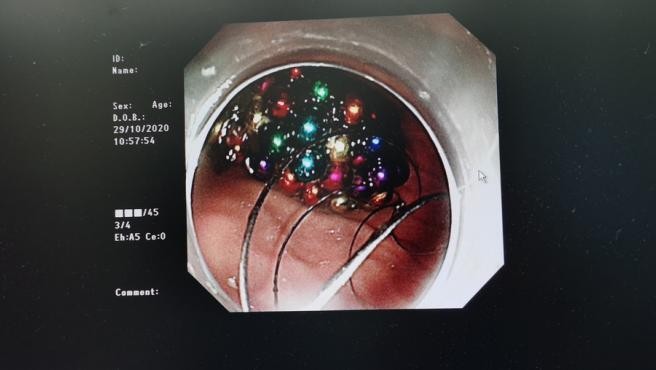 Un nene se tragó 123 bolitas magnéticas mientras miraba televisión | Curiosidades