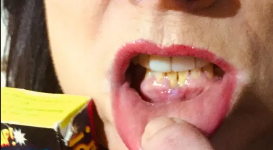 Sufrió quemaduras en la boca al confundir fuegos artificiales con caramelos | Internacionales