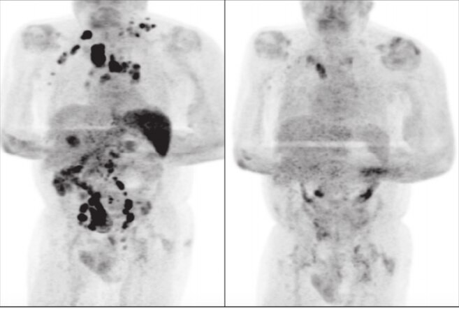 Investigan el caso de un hombre que se curó de cáncer tras contagiarse coronavirus | Internacionales