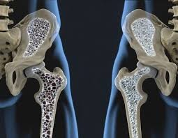Utilizan nanotecnología para potenciar la eficacia de medicamento para la osteoporisis | Salud