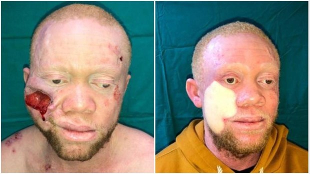 Le reconstruyeron la cara a un hombre que sufría un avanzado cáncer de piel | Internacionales