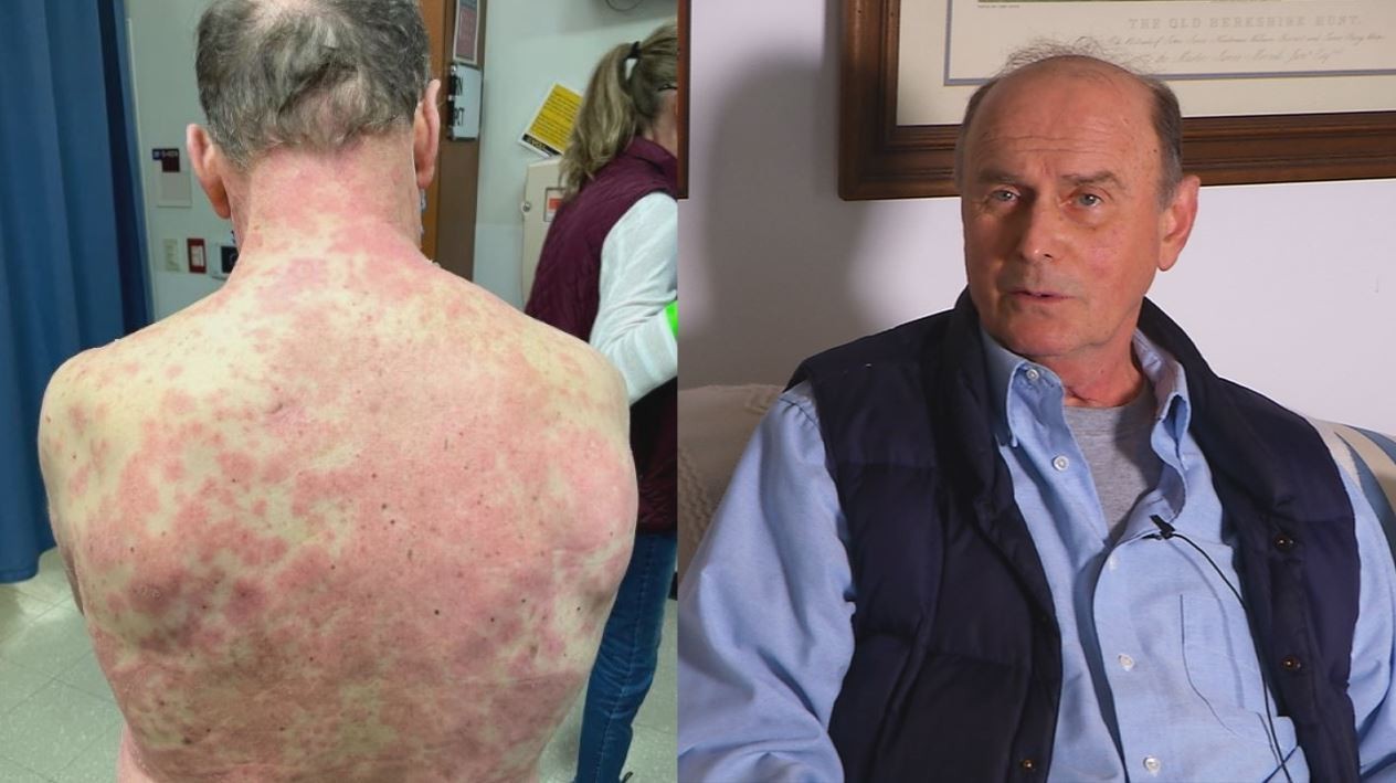 Un hombre sufre una extraña reacción en la piel tras recibir la vacuna de Johnson & Johnson | Internacionales