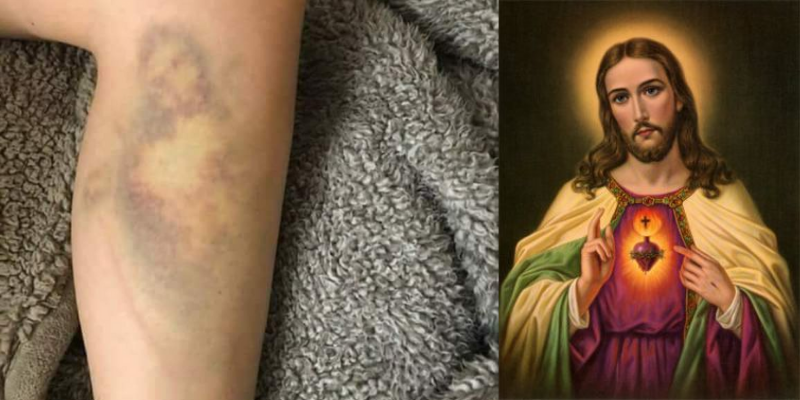 Se cayó de la bicicleta y le salió un moretón con la cara de Jesús | Curiosidades