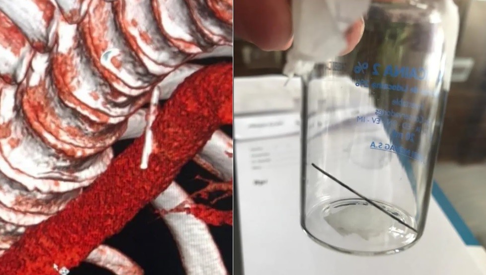 Hospital Durand: le salvaron la vida a un hombre que se tragó una aguja al comer un sandwich | Actualidad