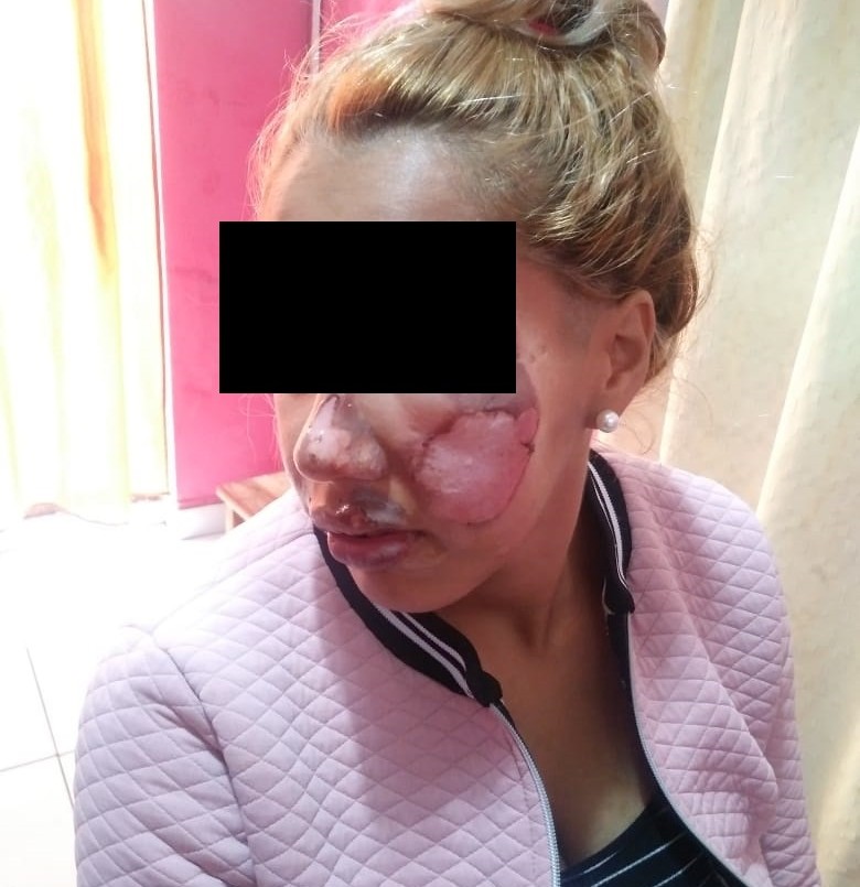 Detienen al hombre que le quemó la cara con una plancha a su novia | Actualidad