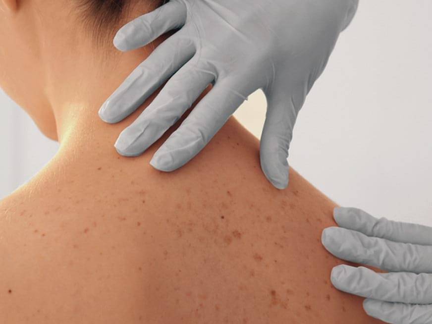 Presentan tecnología israelí para diagnosticar cáncer de piel en segundos | Internacionales