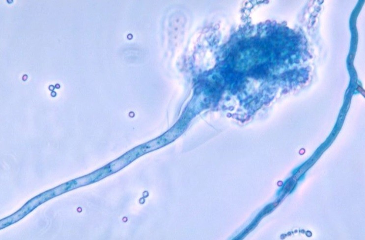 Estudio: científicas argentinas detectan un hongo que causa infección en pacientes graves con coronavirus | Actualidad