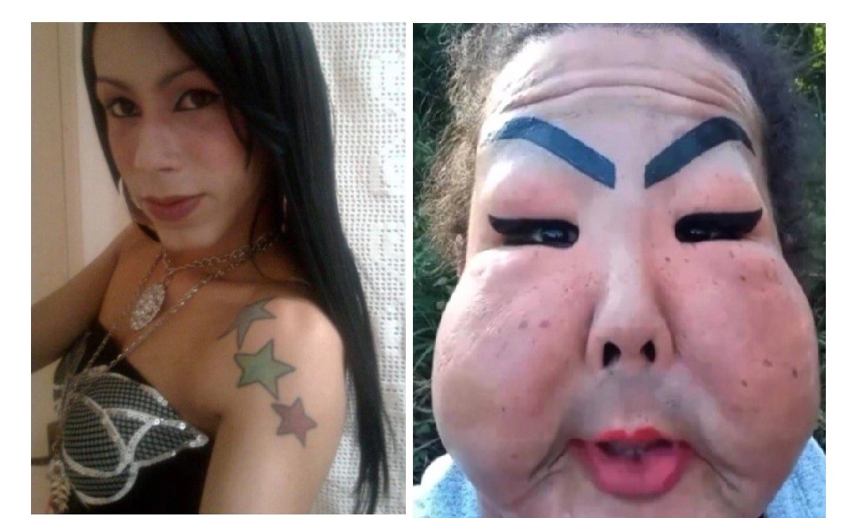 "Lamento habérmelo puesto": mujer trans se inyectó silicona industrial en la cara | Internacionales