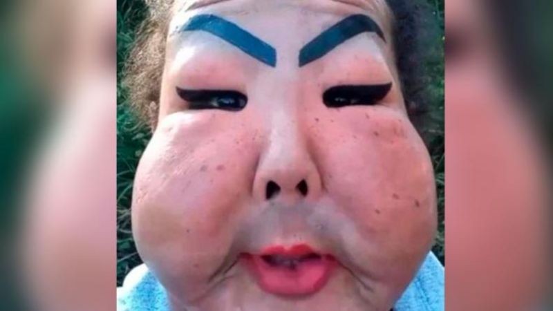 Cirugía estética con silicona industrial: Le desfiguraron el rostro a una mujer | Internacionales