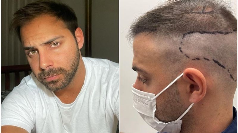 Grego Rosello mostró el proceso de su implante capilar: “Lo ideal sería aceptarnos como somos, pero es jodido” | Espectáculos