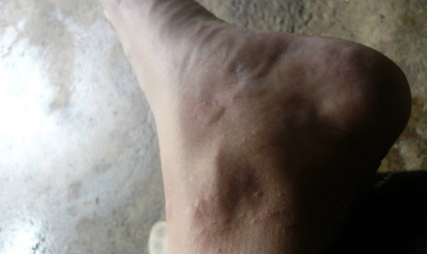 Contrajo tres enfermedades diferentes tras una picadura | Internacionales