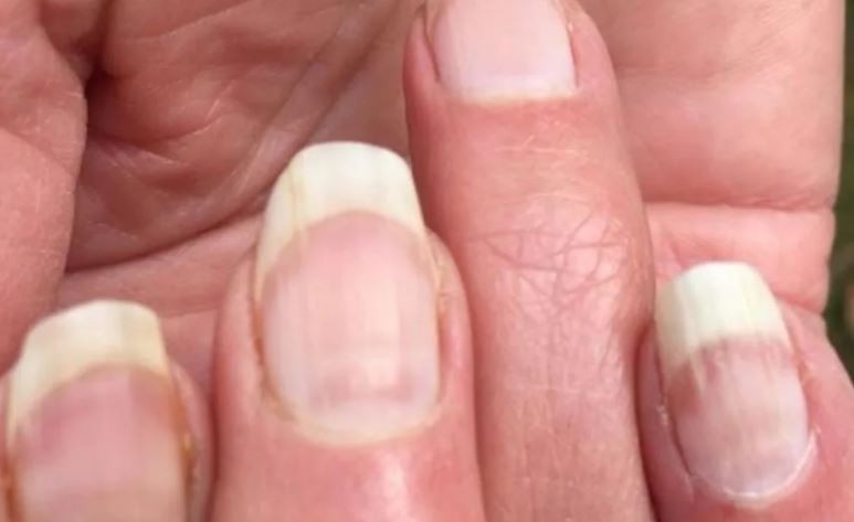 En las uñas se puede detectar si alguien tuvo coronavirus asintomático | Actualidad