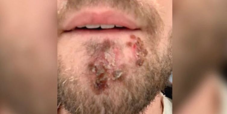 Usó la afeitadora de un amigo y se contagió de una bacteria carnívora | Internacionales