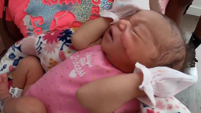 Le cortaron la cara una beba durante la cesárea: la explicación de los médicos | Internacionales