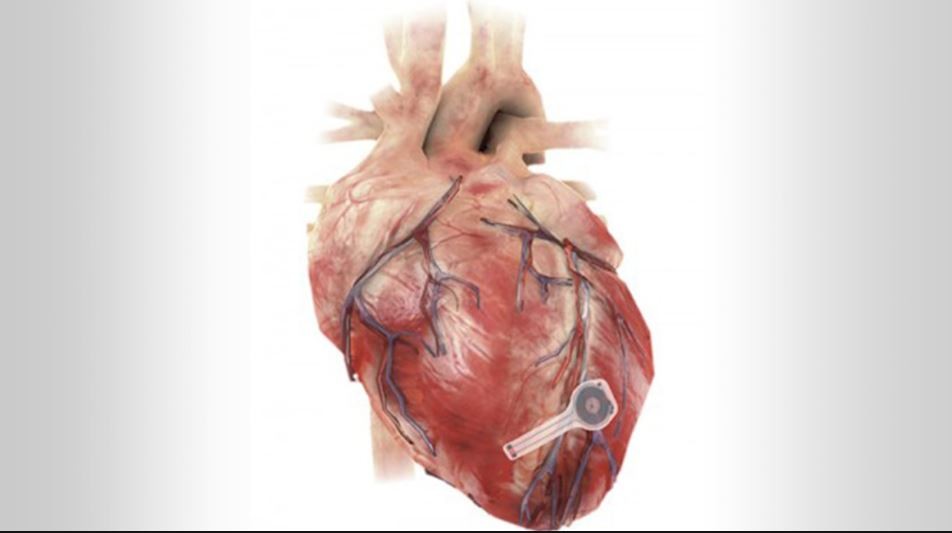 Crean un primer marcapasos biodegradable: desaparece cuando ya no es necesario | Salud