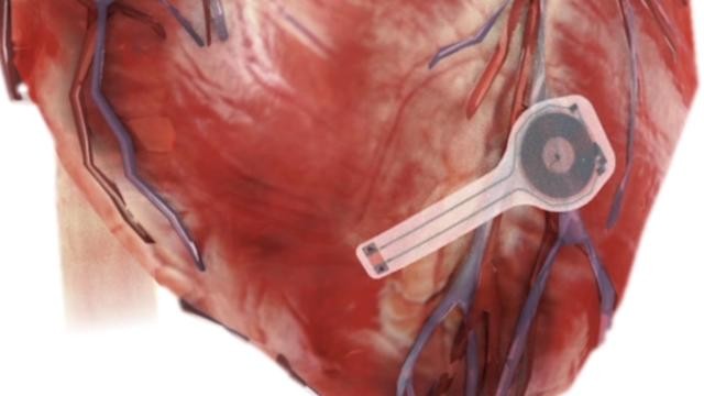 Crearon un marcapasos que se disuelve en el cuerpo | Curiosidades