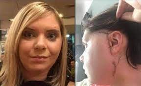 Pidió una hamburguesa triple y se dislocó la mandíbula: "Se arruinó mi vida" | Internacionales