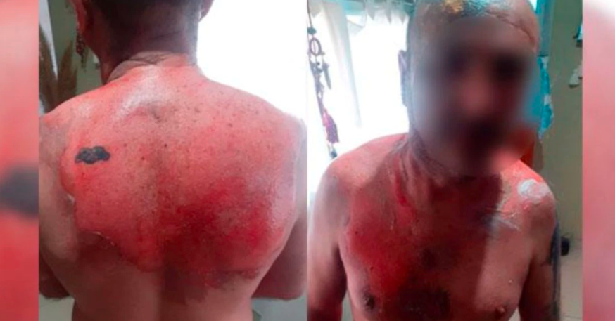 Anisacate: un hombre fue atacado por su expareja con agua hirviendo | Córdoba