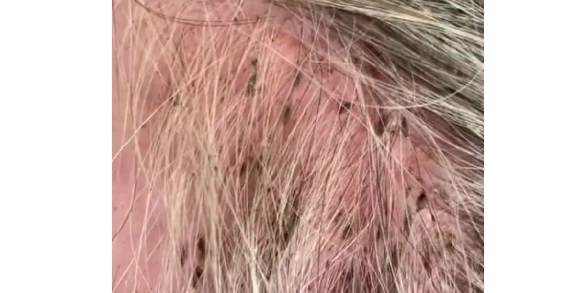 Video: internaron a una mujer de 90 años por una grave infección de piojos en su cabeza | Internacionales