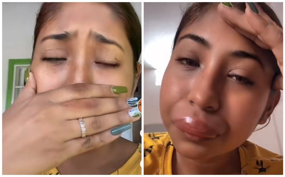 Video: una chica se volvió viral al mostrar cómo le quedaron los labios tras la picadura de una abeja | Internacionales