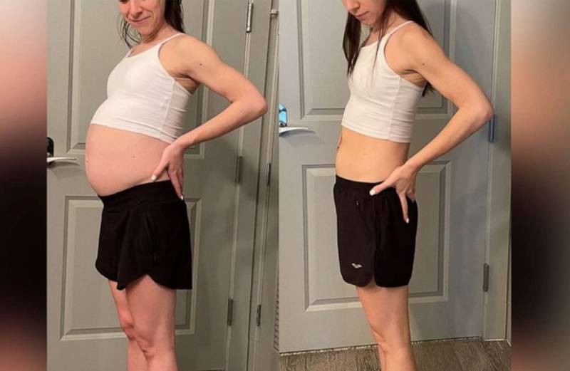 Hizo dieta y ejercicios durante 8 meses, pero no adelgazaba: le descubrieron un enorme tumor en el estómago | Internacionales