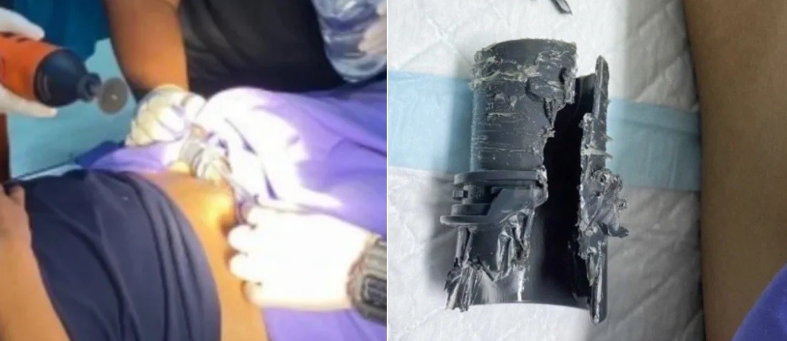 Se agrandó el pene y se le quedó atascado en un tubo que usó para comprobar el nuevo tamaño | Internacionales