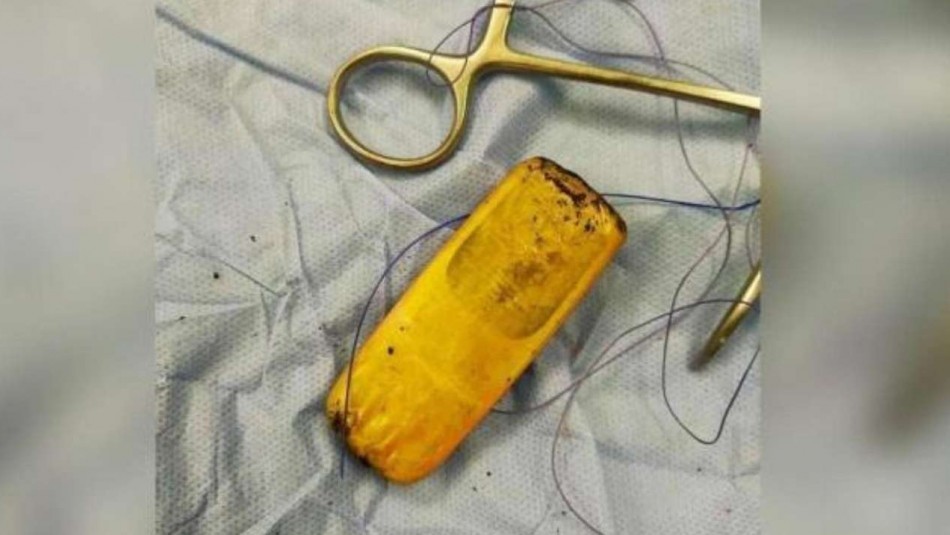 Se quejaba de un fuerte dolor y descubrieron que tenía un celular en los intestinos | Internacionales