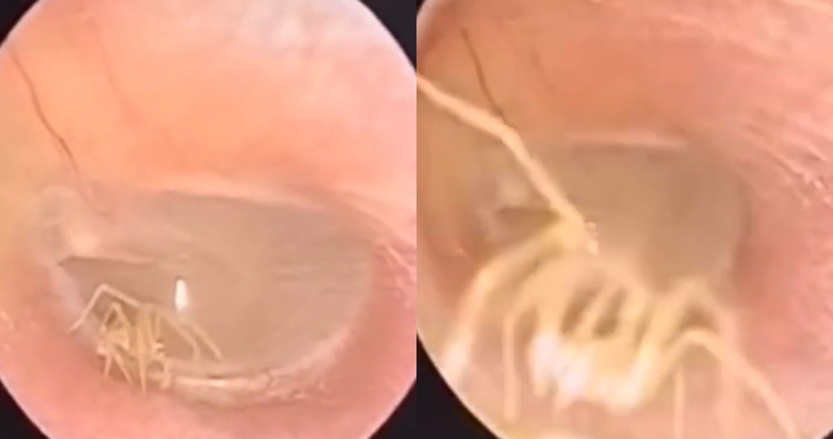 VIDEO: así descubrieron una araña que anidó en el oído de una mujer | Redes