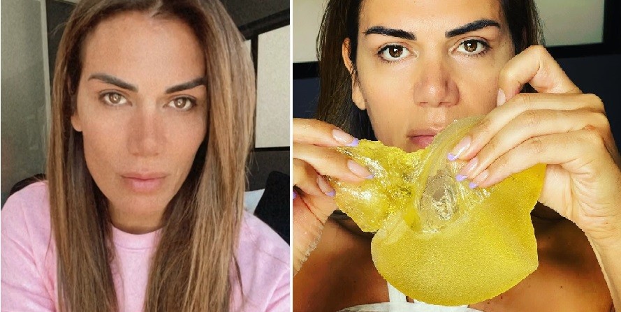 Flor de la V contó que debió operarse por una fisura en un implante mamario | Espectáculos