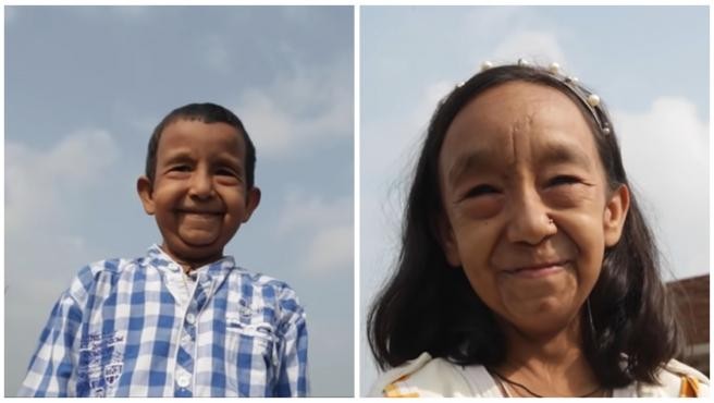 La historia de "los hermanos Benjamin Button": dos nenes que aparentan tener 80 a causa de una rara enfermedad | Internacionales