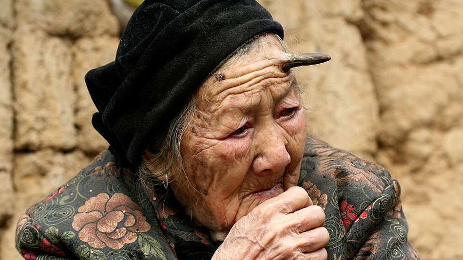 La historia de la mujer de 101 años a la que le salió un cuerno en la frente | Curiosidades