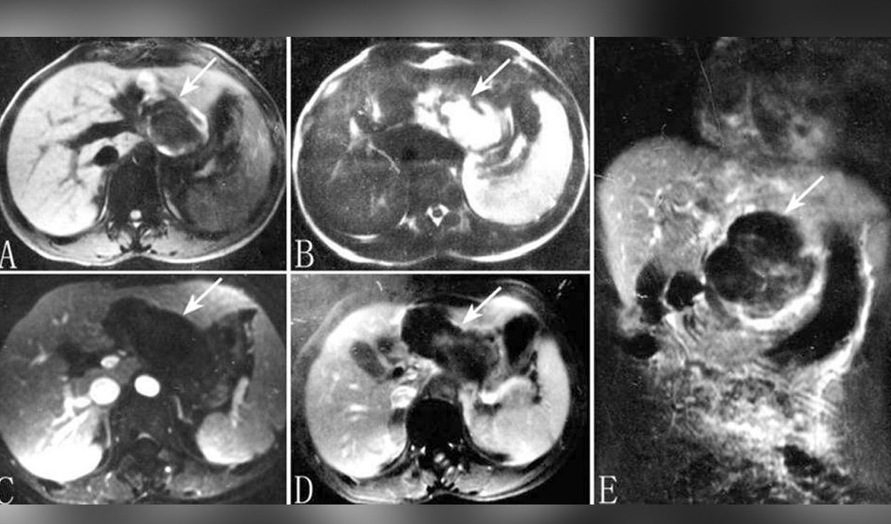 "Jamás vi algo así": pediatra atendió a una mujer embarazada con el feto en el hígado | Internacionales