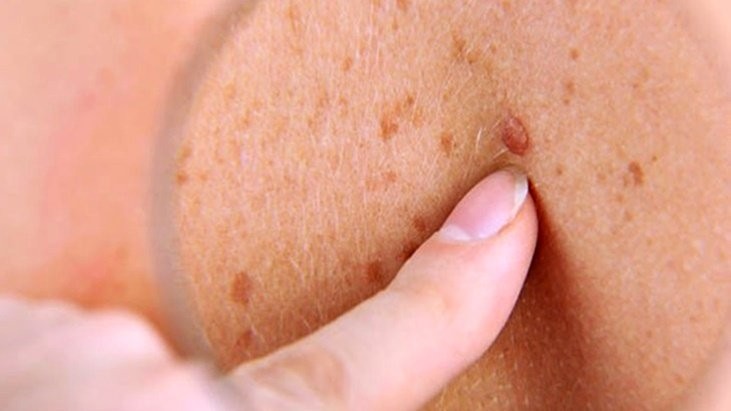 El cáncer de piel es el más común luego de los 40 años | Salud